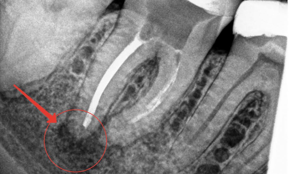 Как выглядит гранулема зуба на рентгене