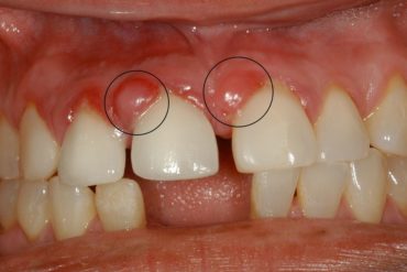 Гранулема зуба - лечение лазером