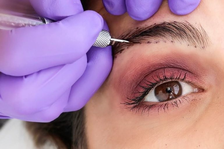 Микроблейдинг или татуаж, удаление их лазером