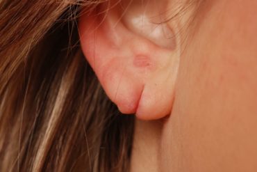 Лазерная пластика мочки уха