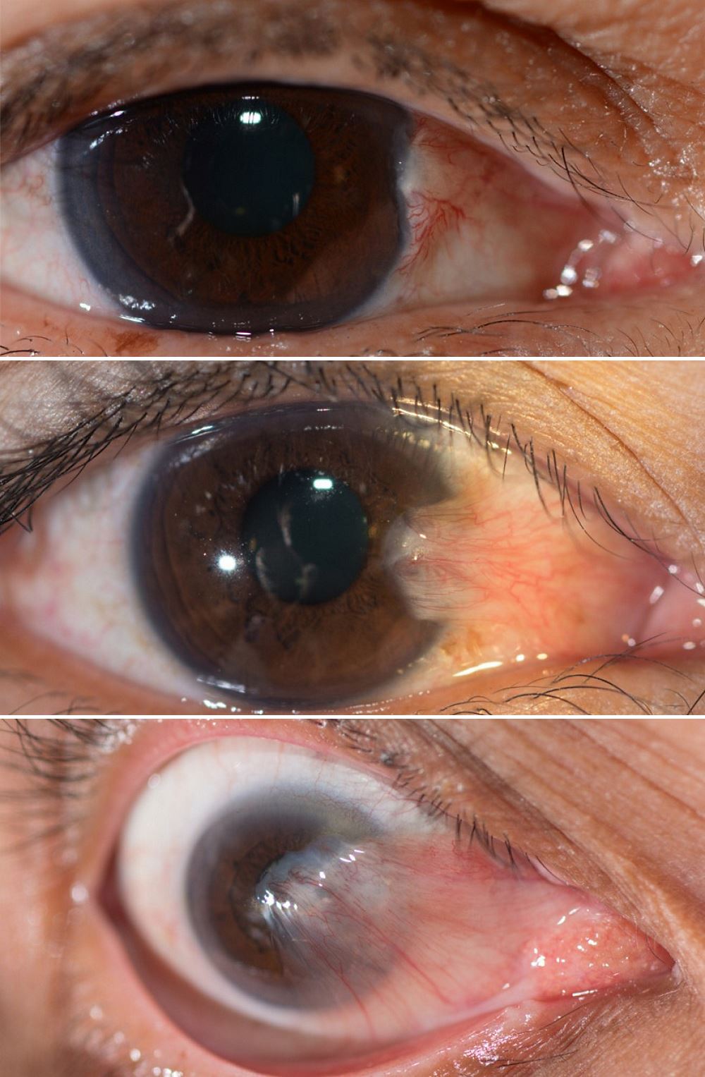 Стадии развития птеригиума глаза