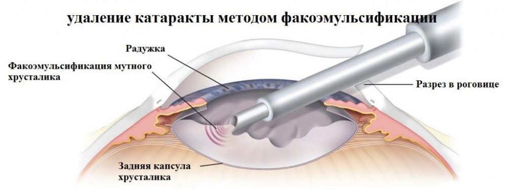 Факоэмульсификация катаракты