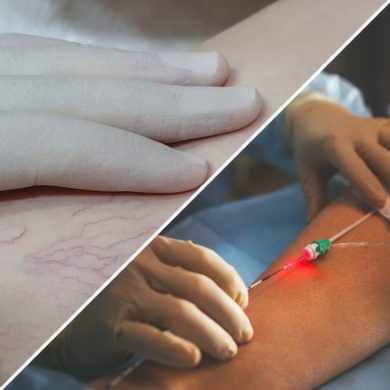 Что лучше склеротерапия или лазерная коагуляция