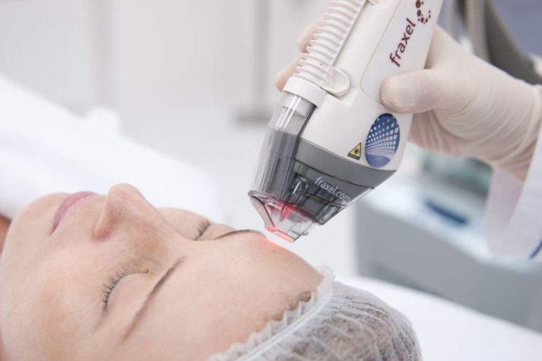 Лазерный термолифтинг лица