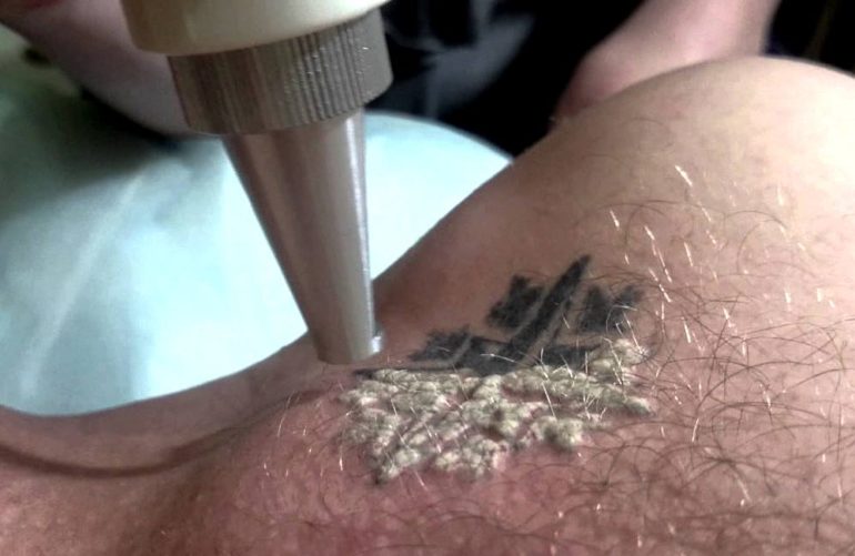Неодимовый лазер для удаления тату
