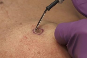Удаление бородавки электрокоагуляцией