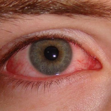 Синдром сухого глаза и ДЭНС терапия