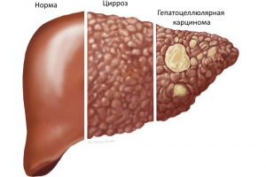 Гены, связанные с наиболее распространенным раком печени