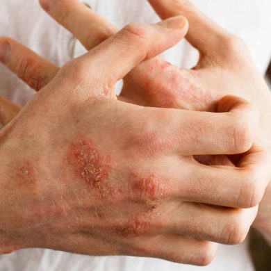 Природная генная терапия для лечения трудноизлечимых заболеваний кожи