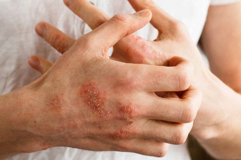 Природная генная терапия для лечения трудноизлечимых заболеваний кожи