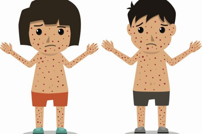 Снижение вакцинации против кори приводит к предотвратимому глобальному возрождению заболевания