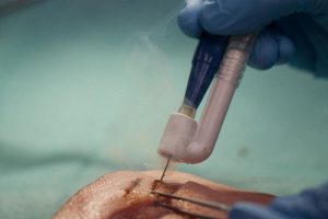 Искусственный нос выявляет злокачественные ткани в опухолях головного мозга во время операции