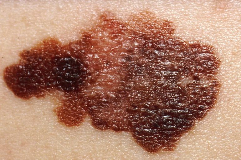 Белок, связанный с агрессивным раком кожи