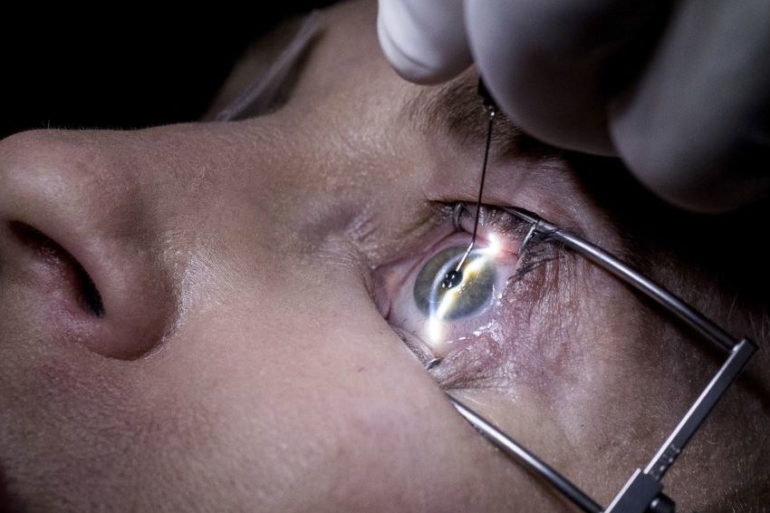 Лазерная коррекция зрения при лечении миопии