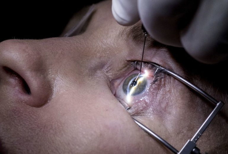 Лазерная коррекция зрения при лечении миопии