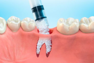 Регенерация зубов - возможно ли такое?