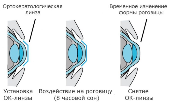 Что собой представляют жесткие контактные линзы