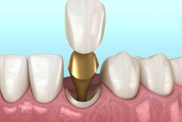 Как проходит процесс установки зубной коронки?