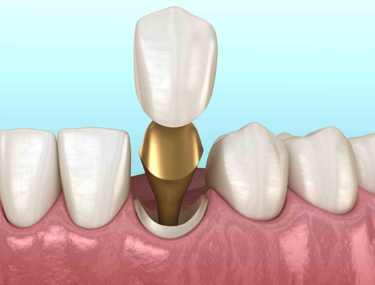 Как проходит процесс установки зубной коронки?