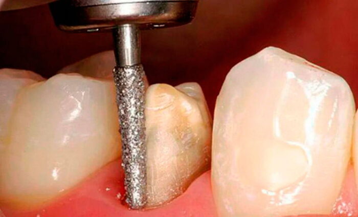 Обточка зуба для установки коронки