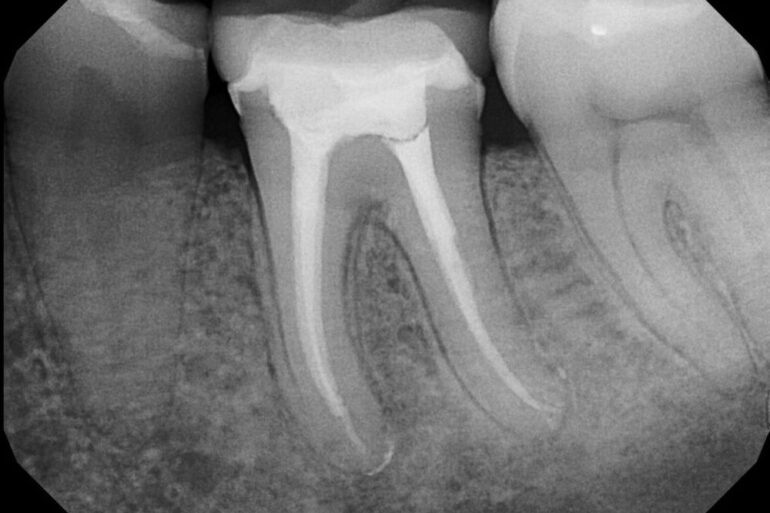 Какие есть материалы для пломбирования корневых каналов?