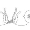 Анальные бахромки - что это такое, симптомы и методы лечения