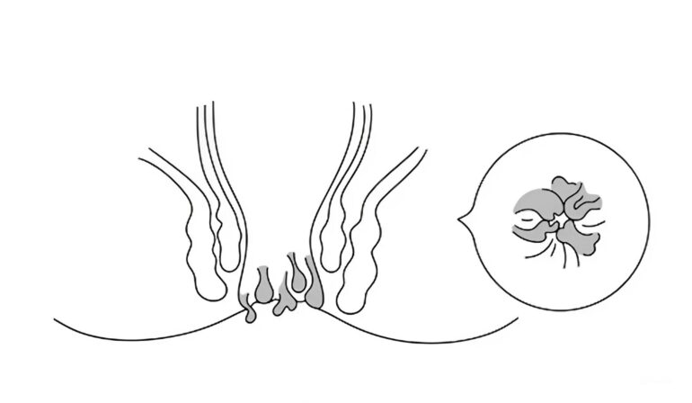 Анальные бахромки - что это такое, симптомы и методы лечения
