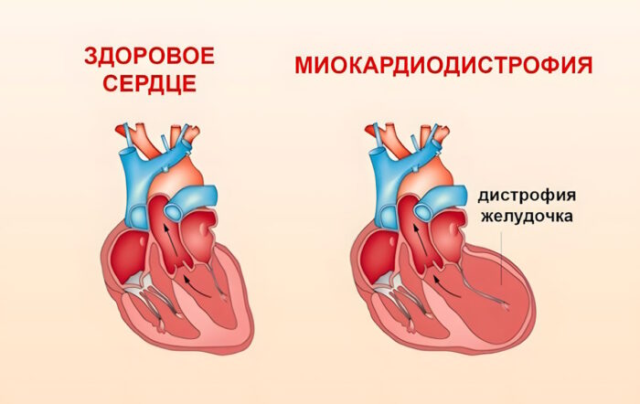 Миодистрофия сердца