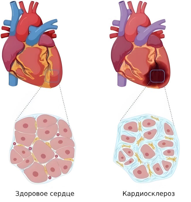 Склероз мышцы сердца