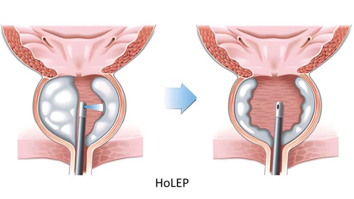 HoLEP