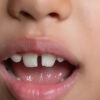 Диастема у детей 5–7 лет: когда это норма, а когда — повод обратиться к стоматологу