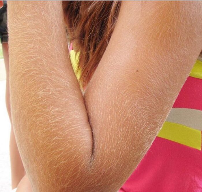 Гипертрихоз