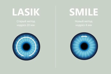 Кому НЕ надо делать SMILE: когда ФемтоЛАСИК объективно лучше