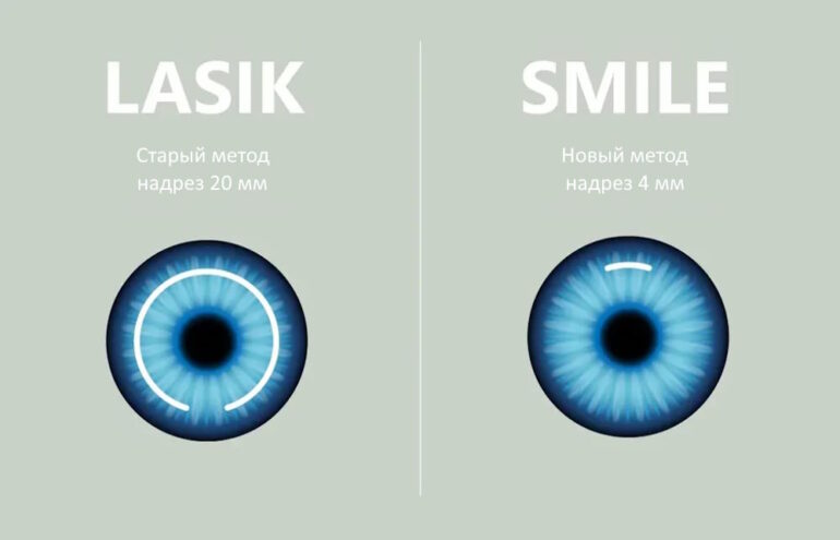 Кому НЕ надо делать SMILE: когда ФемтоЛАСИК объективно лучше