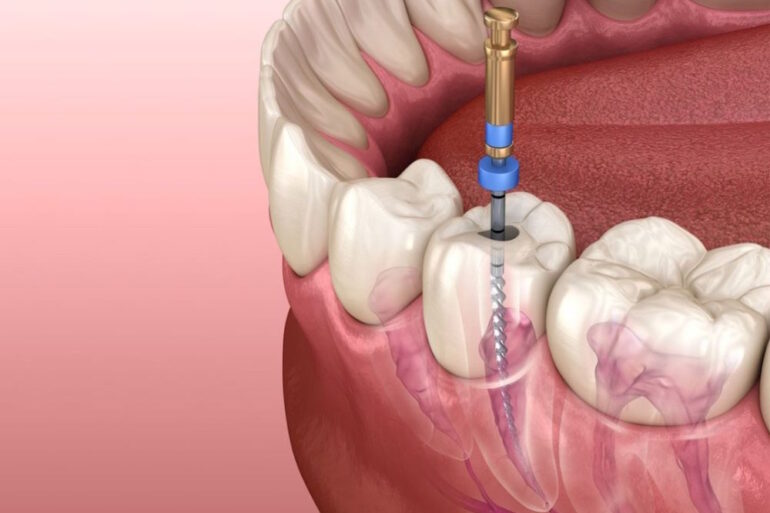 Сколько болит зуб после удаления нерва по часам