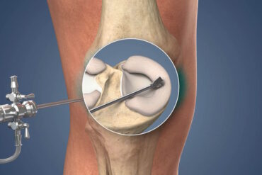 Артроскопическая пластика связок