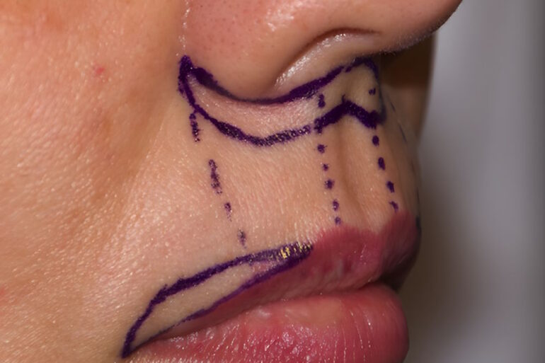 Пластика верхней губы: когда филлеры не справляются и нужен хирург