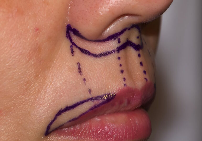Пластика верхней губы: когда филлеры не справляются и нужен хирург